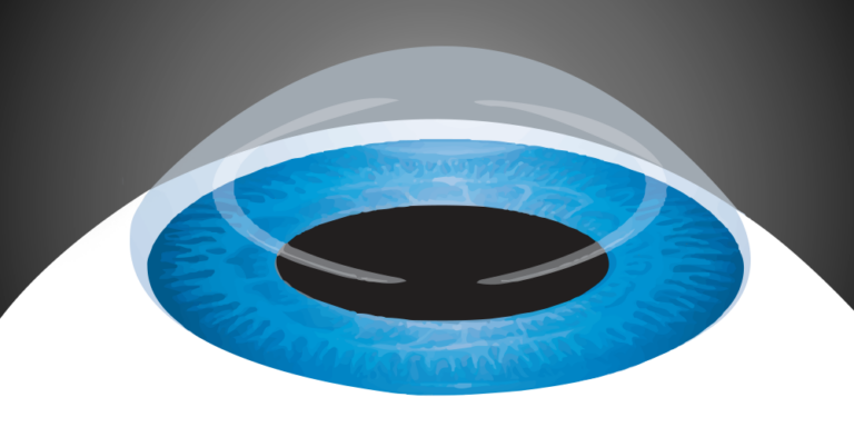 Keratoconus Management (ICRS & CXL) - مركز الدكتور محمد عمر يوسف